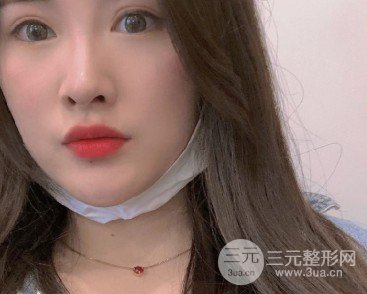 像素激光去痘印果