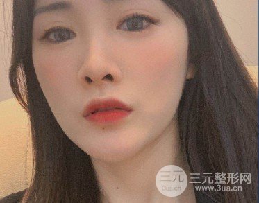 像素激光去痘印果