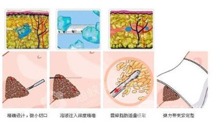 腹部吸脂的费用高吗