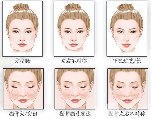 磨骨手术价位多少