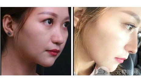 人工骨隆鼻吸收率是多少