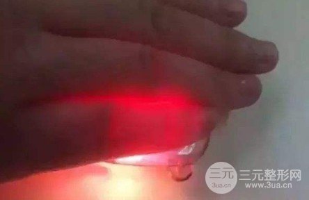 隆鼻手术危险吗