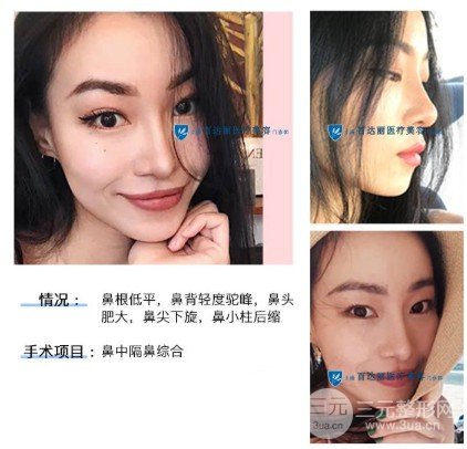 隆鼻手术危险吗