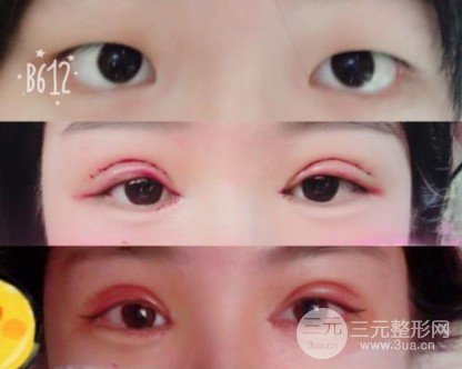 肿眼泡割了双眼皮想死