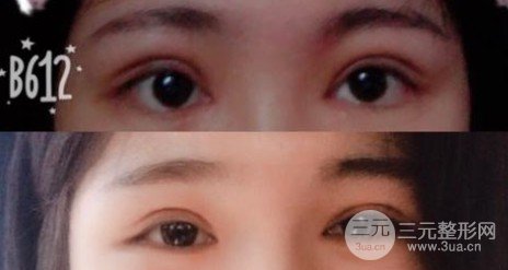 肿眼泡割了双眼皮想死
