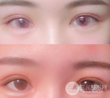 肿眼泡割了双眼皮想死