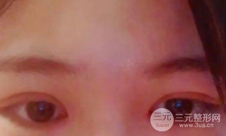肿眼泡割了双眼皮想死