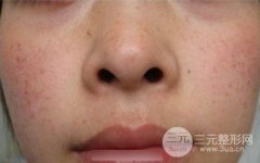 激光祛斑失败后的图片，不想返黑就乖乖防护!