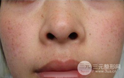 激光祛斑失败