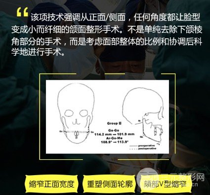 磨下颌骨要多少钱