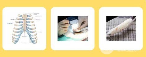 耳软骨垫鼻尖多久消肿