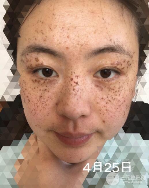 激光祛斑后的护理