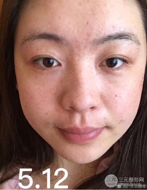 激光祛斑失败后的图片