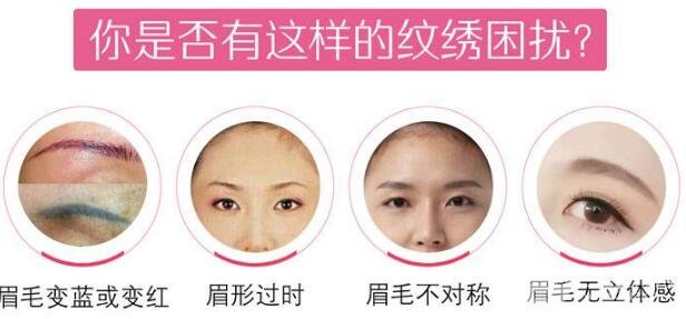 激光洗眉手术