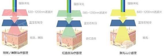 激光洗眉多少钱