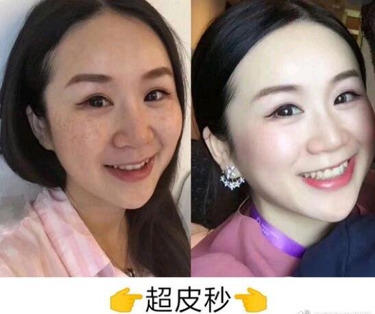 激光洗眉的基本原理
