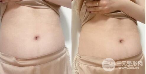 腰腹吸脂手术前