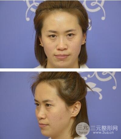 手术前的眼袋
