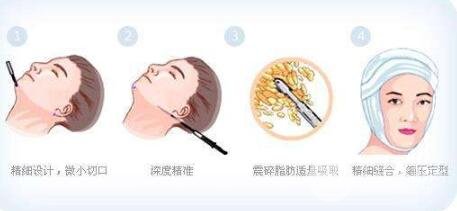 面部抽脂后皮肤会松弛吗?