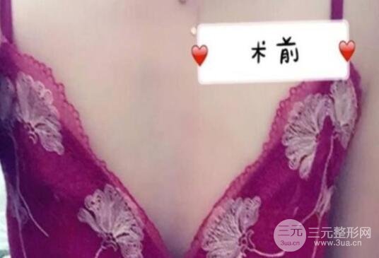 做隆胸手术前