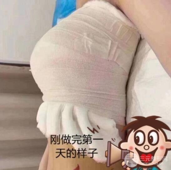 做隆胸手术前