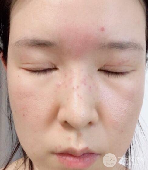 我的斑点结痂了