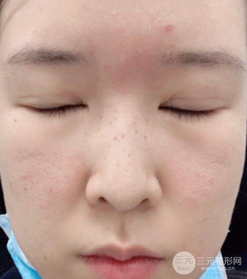 我的斑点结痂了
