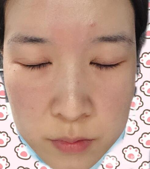我的斑点结痂了