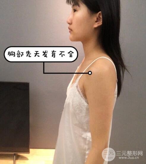 隆胸前的我