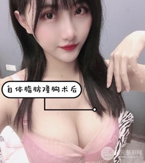 脂肪填充后一个月