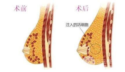 脂肪吸收率取决于这些因素