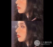 眼袋切除手术能保几年？天生眼袋能手术去除吗?