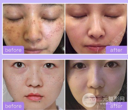 激光祛黄褐斑恢复过程全图