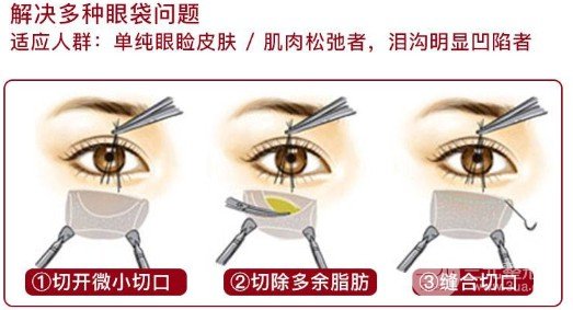 眼袋切除术后多久恢复