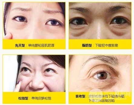 眼袋切除术后多久恢复