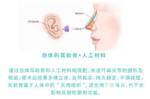 耳软骨垫鼻尖吸收率很高吗