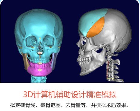 削骨瘦脸手术多少钱