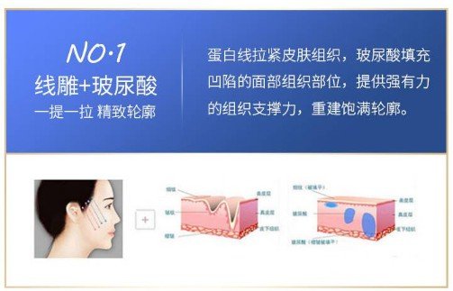 面部轮廓提升针是什么原理