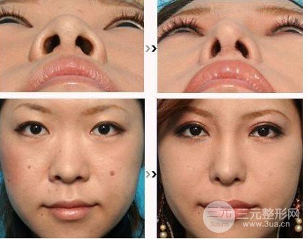 缩鼻翼前后对比照