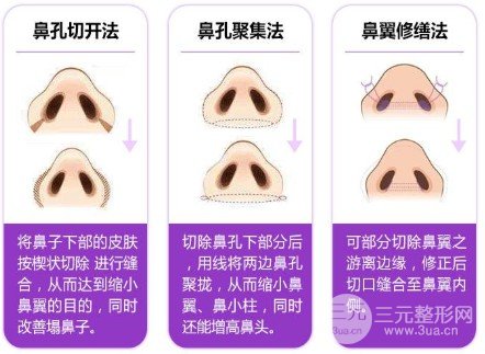 缩鼻翼前后对比照