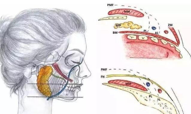 去颊脂垫图颊脂垫位置图示意附上颊脂垫手术案例