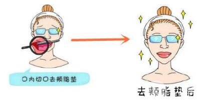 去颊脂垫的注意事项