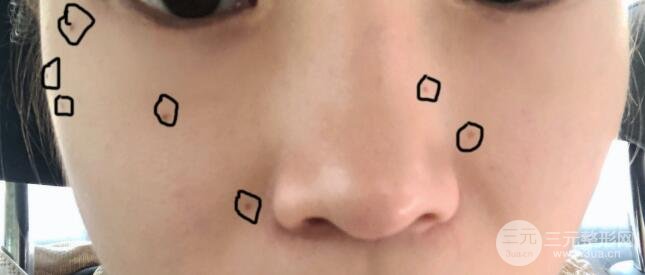 点痣前的照片