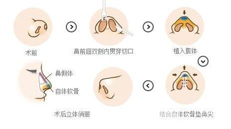 什么是硅胶隆鼻?