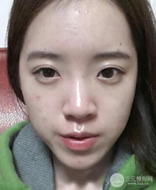 隆鼻案例参考