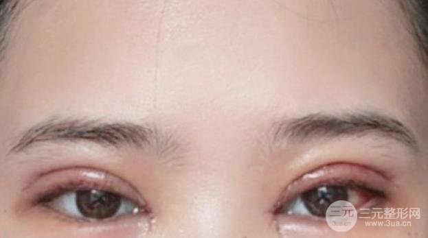 肿眼泡抽脂前后对照图分享肿眼泡全切也可以微创