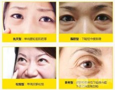 眼袋切除一般需要多少天能恢复？会有痕迹吗?