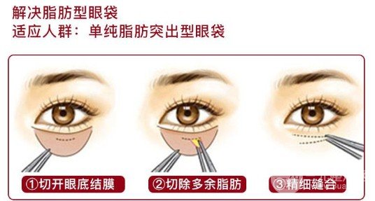眼袋切除一般需要多少天能恢复