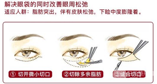眼袋切除一般需要多少天能恢复