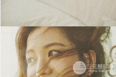 双眼皮手术后恢复期